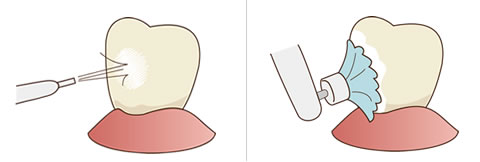 歯の着色を落とすことのイラスト解説