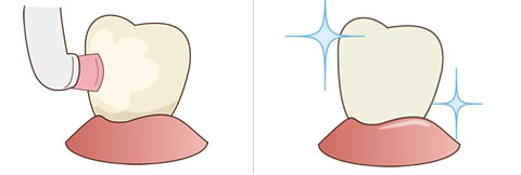 歯の表面をツルツルにして着色しにくくするイラスト解説
