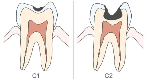 虫歯の進行、C1とC2のイラスト解説