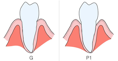 歯周病の進行、GとP1のイラスト解説