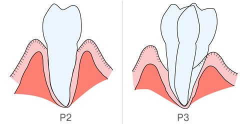 歯周病の進行、P2とP3のイラスト解説