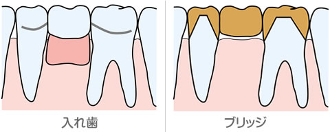 入れ歯とブリッジの比較イラスト解説